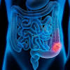 Colon cancer symptoms